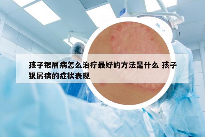 孩子銀屑病怎么治療最好的方法是什么 孩子銀屑病的癥狀表現(xiàn)