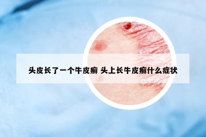 頭皮長(zhǎng)了一個(gè)牛皮癬 頭上長(zhǎng)牛皮癬什么癥狀