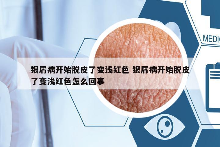 銀屑病開始脫皮了變淺紅色 銀屑病開始脫皮了變淺紅色怎么回事
