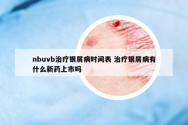 nbuvb治療銀屑病時間表 治療銀屑病有什么新藥上市嗎