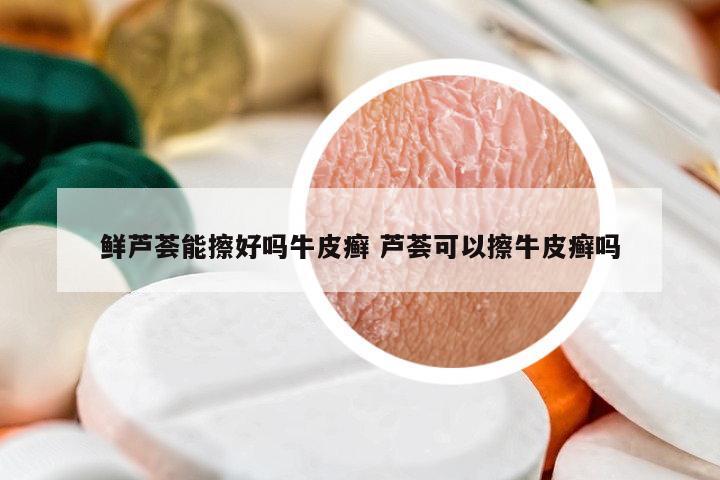 鮮蘆薈能擦好嗎牛皮癬 蘆薈可以擦牛皮癬嗎
