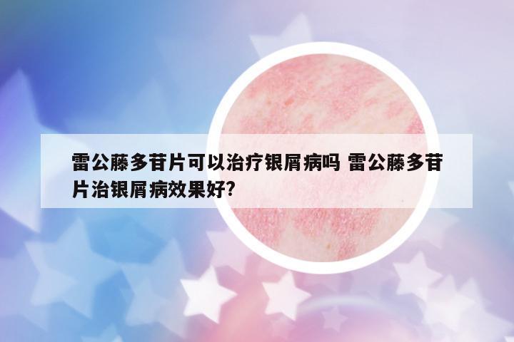 雷公藤多苷片可以治療銀屑病嗎 雷公藤多苷片治銀屑病效果好?