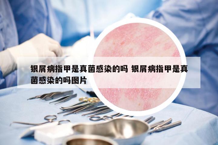 銀屑病指甲是真菌感染的嗎 銀屑病指甲是真菌感染的嗎圖片