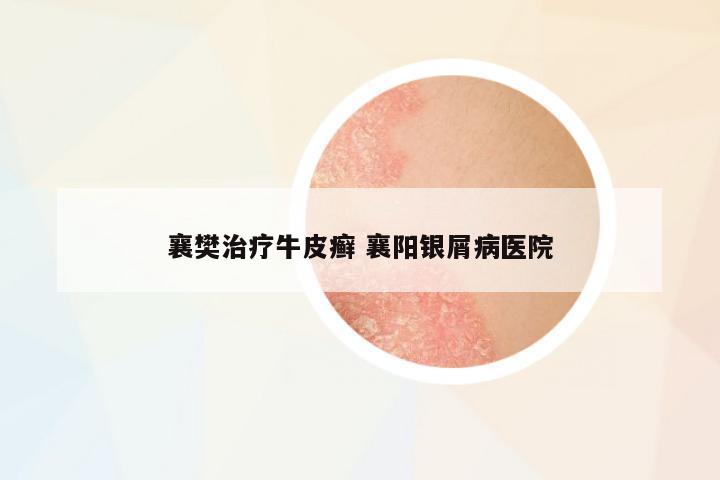 襄樊治療牛皮癬 襄陽銀屑病醫(yī)院