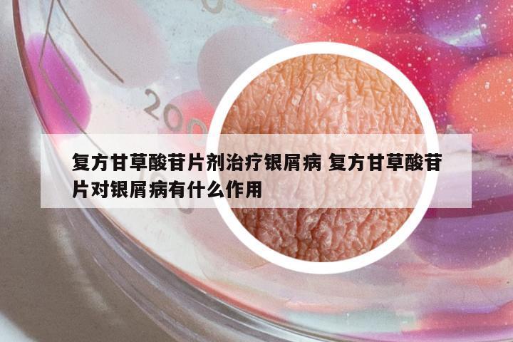 復(fù)方甘草酸苷片劑治療銀屑病 復(fù)方甘草酸苷片對銀屑病有什么作用