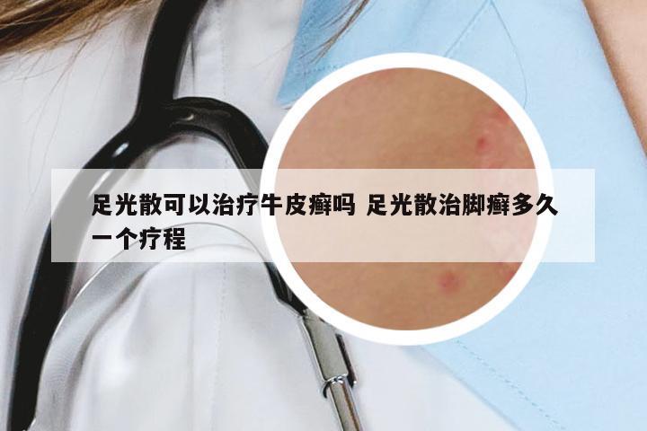 足光散可以治療牛皮癬嗎 足光散治腳癬多久一個療程
