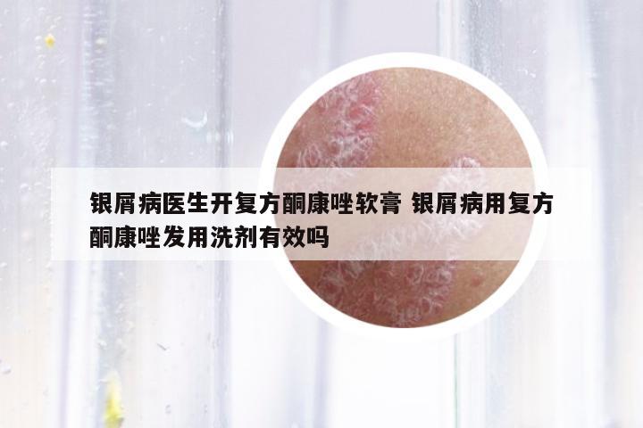 銀屑病醫(yī)生開復方酮康唑軟膏 銀屑病用復方酮康唑發(fā)用洗劑有效嗎