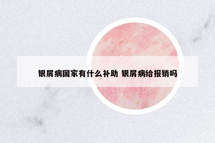銀屑病國家有什么補助 銀屑病給報銷嗎