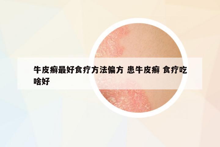 牛皮癬最好食療方法偏方 患牛皮癬 食療吃啥好