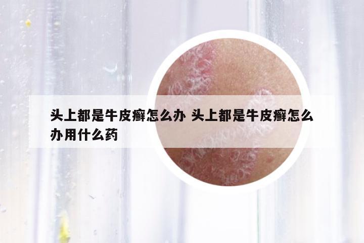 頭上都是牛皮癬怎么辦 頭上都是牛皮癬怎么辦用什么藥
