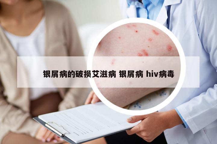銀屑病的破損艾滋病 銀屑病 hiv病毒