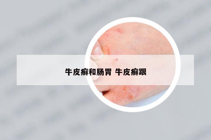 牛皮癬和腸胃 牛皮癬跟
