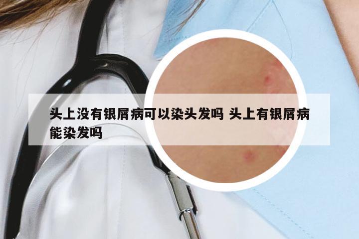 頭上沒有銀屑病可以染頭發(fā)嗎 頭上有銀屑病能染發(fā)嗎