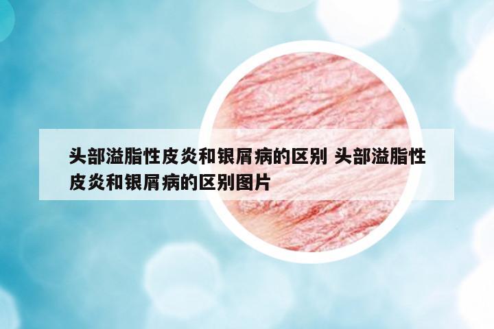 頭部溢脂性皮炎和銀屑病的區(qū)別 頭部溢脂性皮炎和銀屑病的區(qū)別圖片