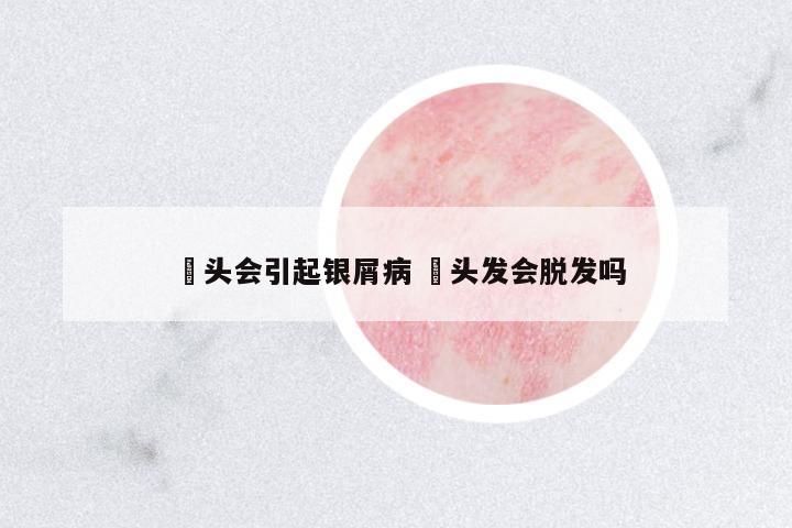 焗頭會引起銀屑病 焗頭發(fā)會脫發(fā)嗎