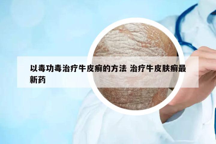 以毒功毒治療牛皮癬的方法 治療牛皮膚癬最新藥