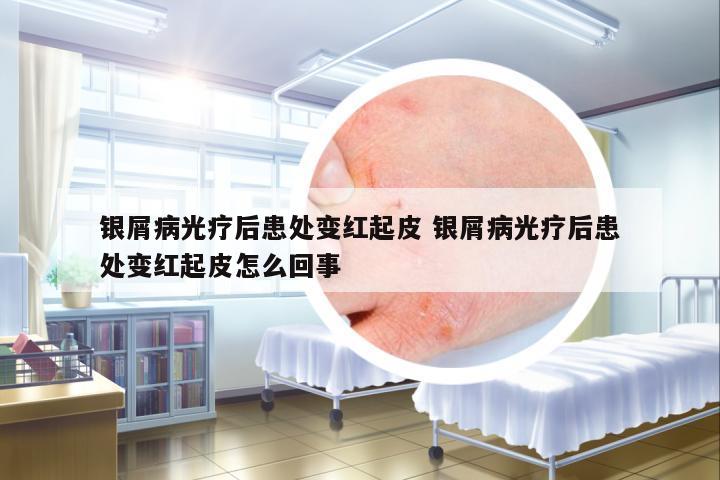 銀屑病光療后患處變紅起皮 銀屑病光療后患處變紅起皮怎么回事