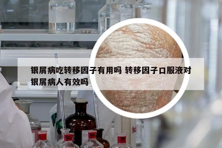 銀屑病吃轉(zhuǎn)移因子有用嗎 轉(zhuǎn)移因子口服液對銀屑病人有效嗎