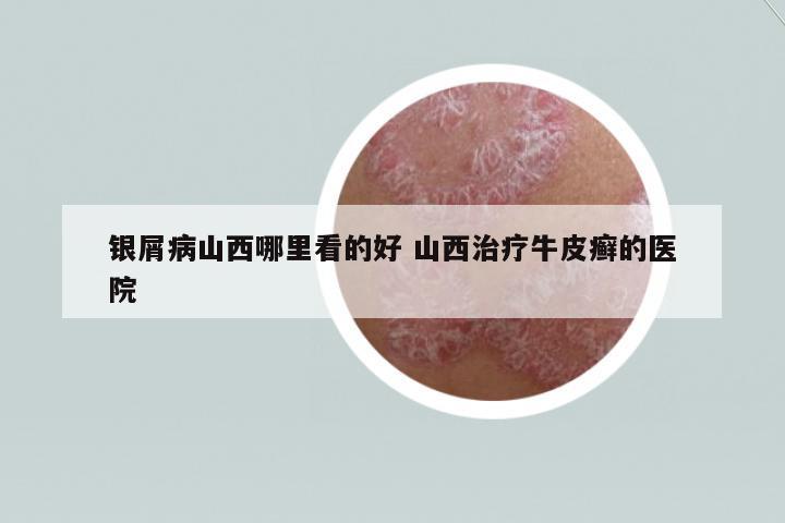 銀屑病山西哪里看的好 山西治療牛皮癬的醫(yī)院