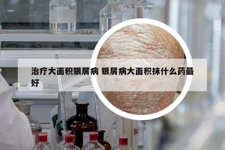 治療大面積銀屑病 銀屑病大面積抹什么藥最好
