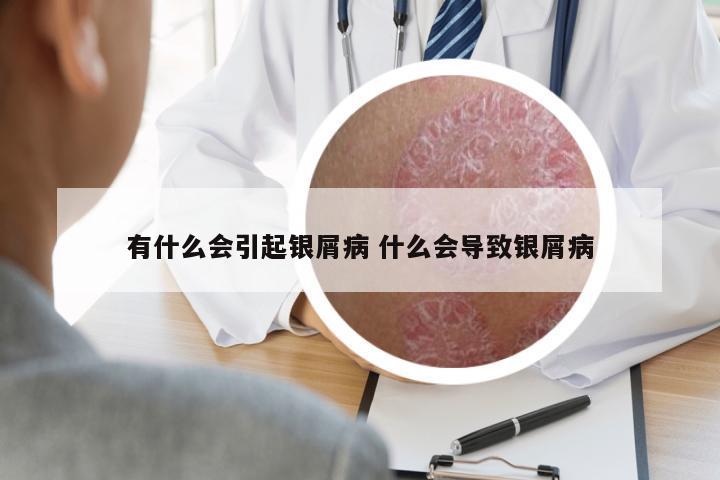 有什么會引起銀屑病 什么會導(dǎo)致銀屑病