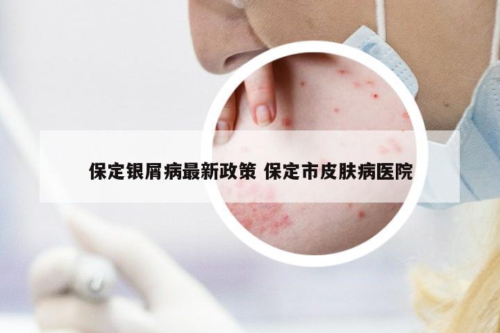 保定銀屑病最新政策 保定市皮膚病醫(yī)院