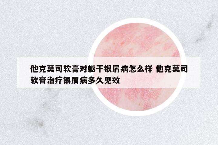 他克莫司軟膏對軀干銀屑病怎么樣 他克莫司軟膏治療銀屑病多久見效