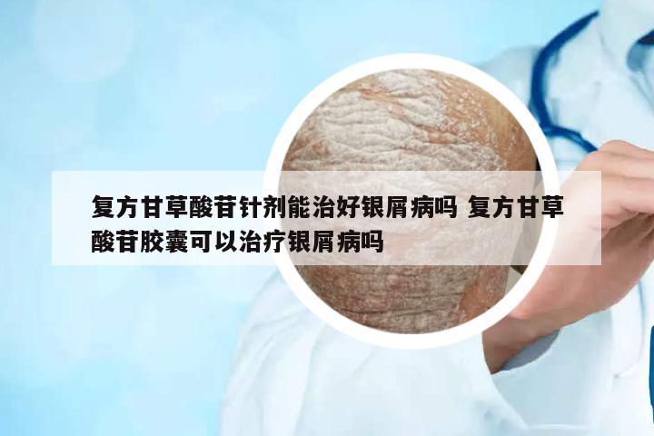復(fù)方甘草酸苷針劑能治好銀屑病嗎 復(fù)方甘草酸苷膠囊可以治療銀屑病嗎