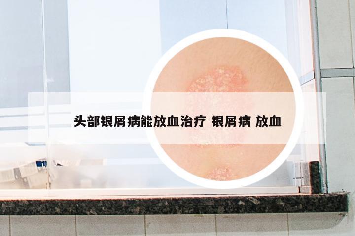 頭部銀屑病能放血治療 銀屑病 放血