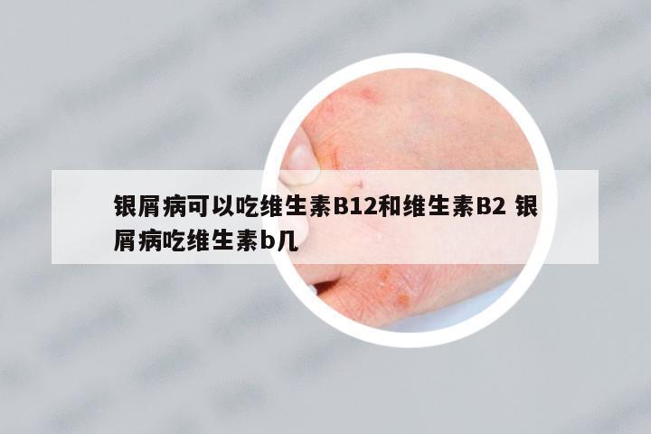 銀屑病可以吃維生素B12和維生素B2 銀屑病吃維生素b幾