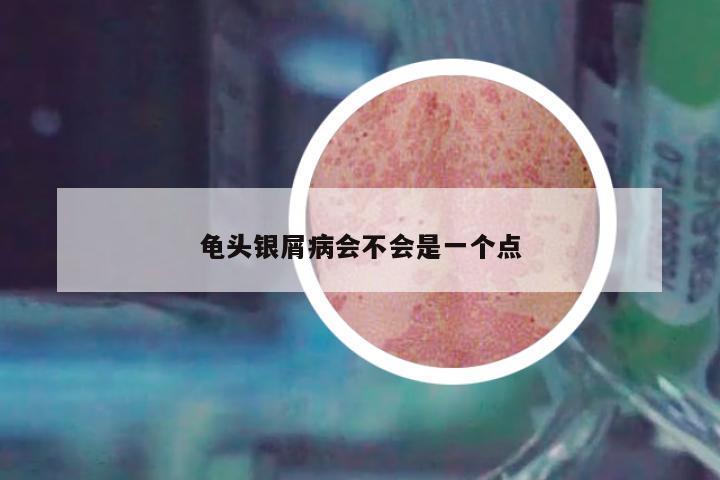 龜頭銀屑病會不會是一個點