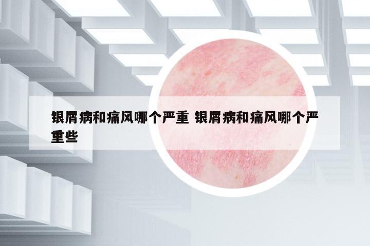 銀屑病和痛風(fēng)哪個(gè)嚴(yán)重 銀屑病和痛風(fēng)哪個(gè)嚴(yán)重些