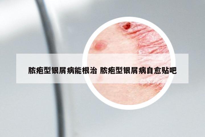 膿皰型銀屑病能根治 膿皰型銀屑病自愈貼吧