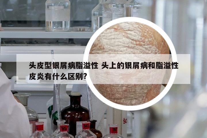 頭皮型銀屑病脂溢性 頭上的銀屑病和脂溢性皮炎有什么區(qū)別?