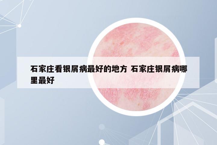 石家莊看銀屑病最好的地方 石家莊銀屑病哪里最好