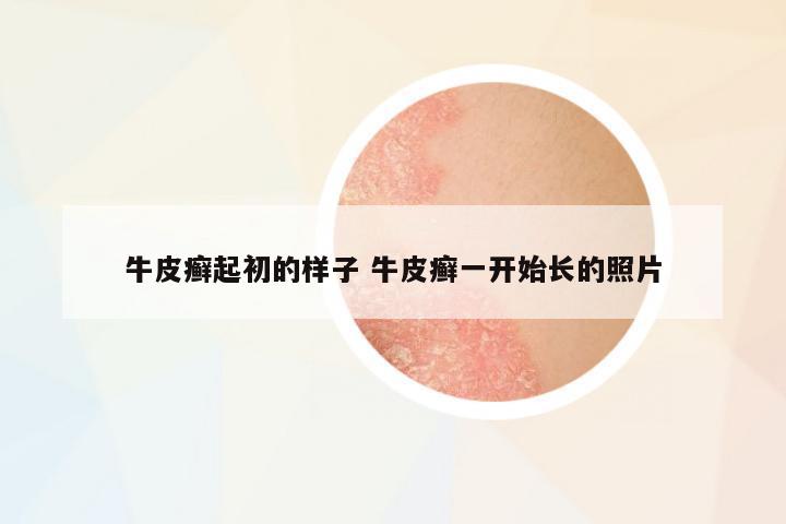 牛皮癬起初的樣子 牛皮癬一開始長(zhǎng)的照片