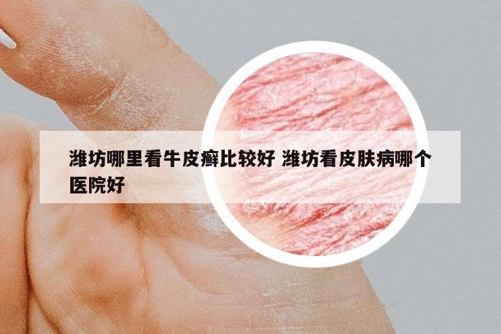 濰坊哪里看牛皮癬比較好 濰坊看皮膚病哪個醫(yī)院好