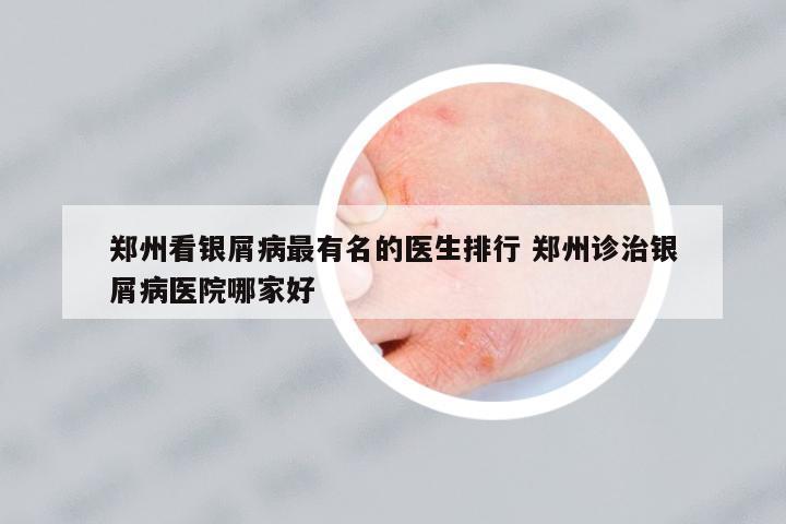 鄭州看銀屑病最有名的醫(yī)生排行 鄭州診治銀屑病醫(yī)院哪家好