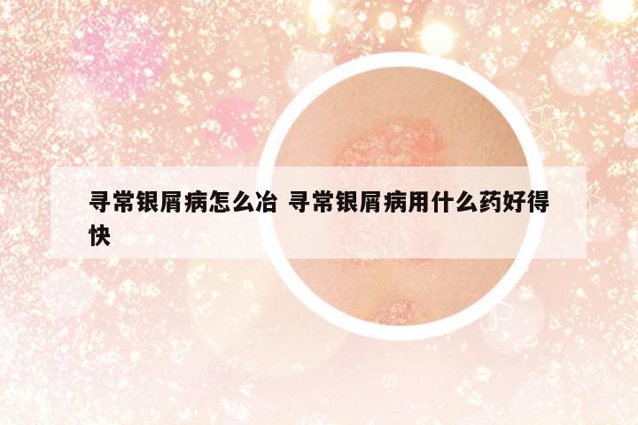尋常銀屑病怎么冶 尋常銀屑病用什么藥好得快
