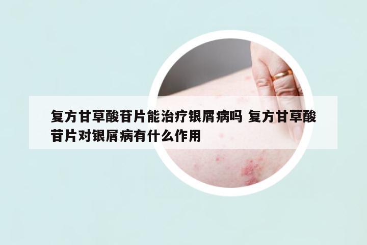 復方甘草酸苷片能治療銀屑病嗎 復方甘草酸苷片對銀屑病有什么作用