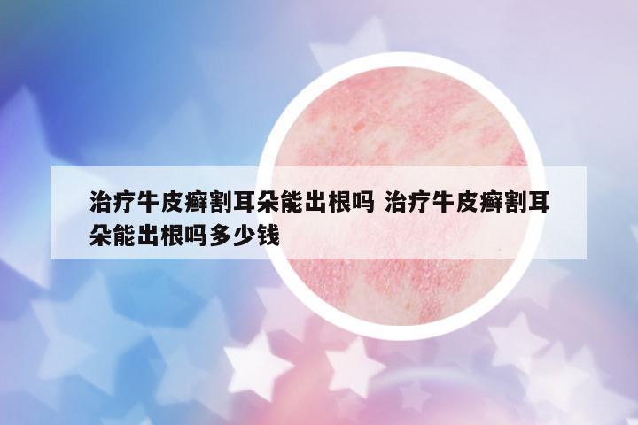 治療牛皮癬割耳朵能出根嗎 治療牛皮癬割耳朵能出根嗎多少錢