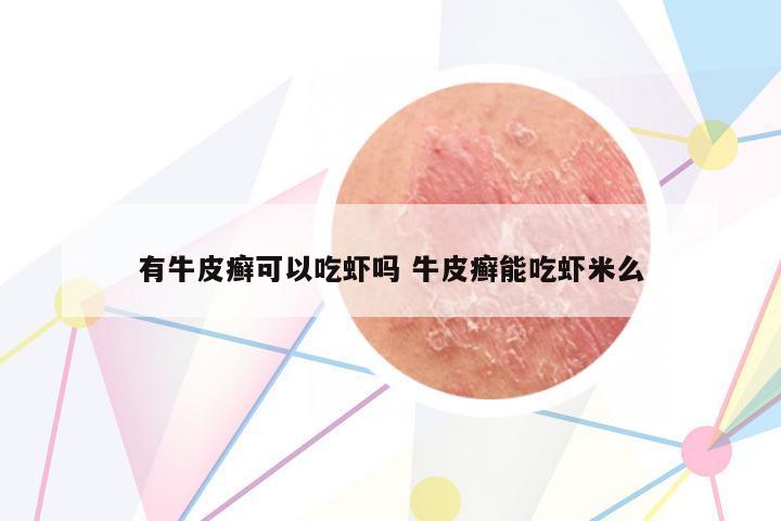 有牛皮癬可以吃蝦嗎 牛皮癬能吃蝦米么