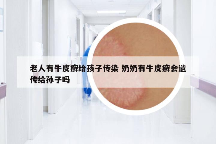 老人有牛皮癬給孩子傳染 奶奶有牛皮癬會(huì)遺傳給孫子嗎