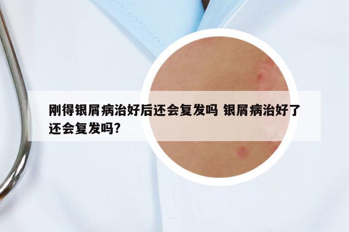 剛得銀屑病治好后還會復發(fā)嗎 銀屑病治好了還會復發(fā)嗎?