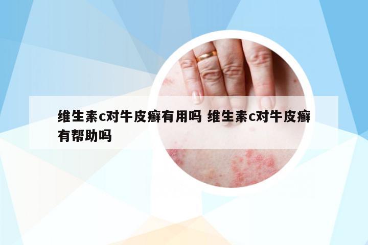 維生素c對牛皮癬有用嗎 維生素c對牛皮癬有幫助嗎