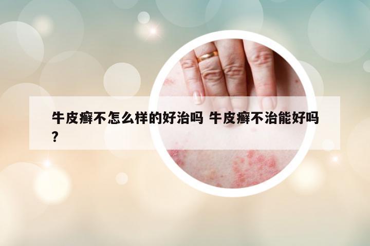 牛皮癬不怎么樣的好治嗎 牛皮癬不治能好嗎?