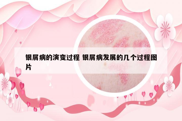 銀屑病的演變過程 銀屑病發(fā)展的幾個(gè)過程圖片