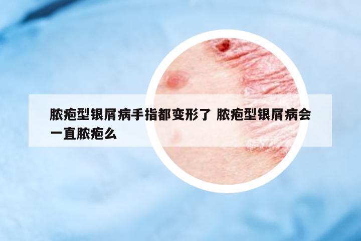 膿皰型銀屑病手指都變形了 膿皰型銀屑病會一直膿皰么