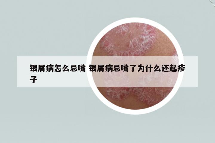 銀屑病怎么忌嘴 銀屑病忌嘴了為什么還起疹子