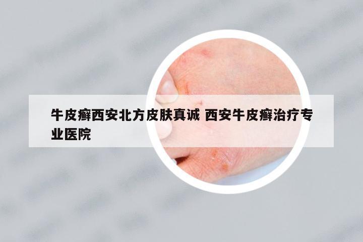 牛皮癬西安北方皮膚真誠(chéng) 西安牛皮癬治療專業(yè)醫(yī)院